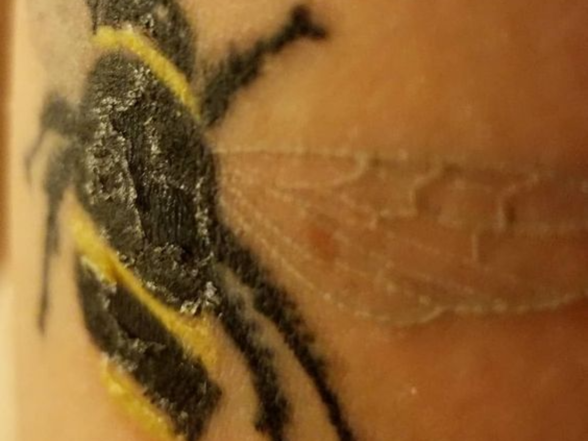 Tattoo Allergy: Can You Be Allergic To Tattoo Ink?